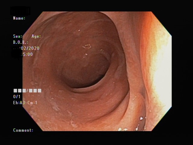 大腸鏡照片