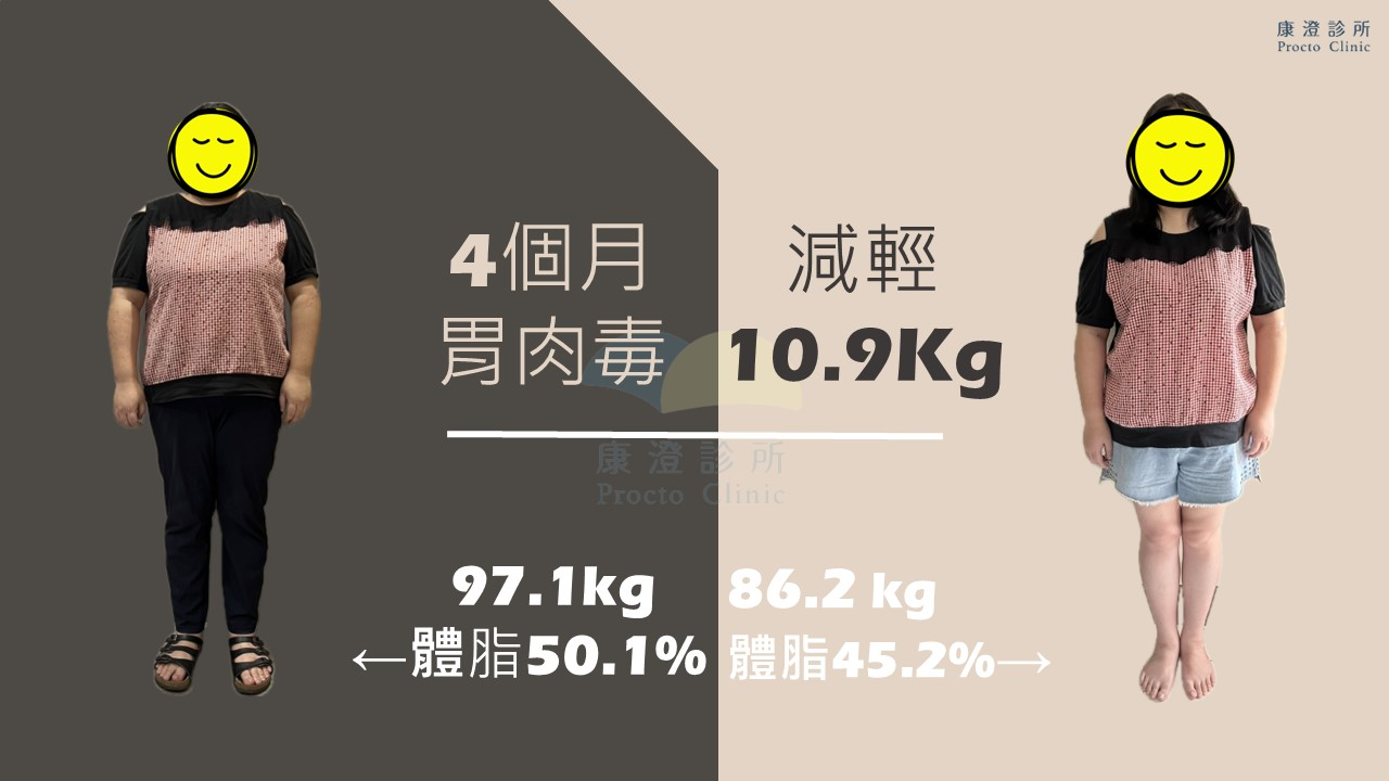 胃肉毒案例一