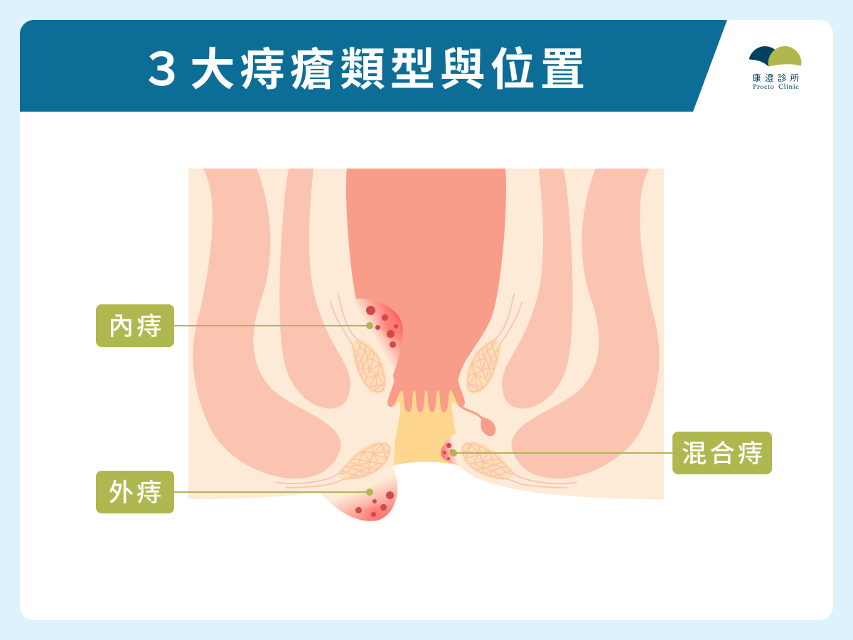 3 大痔瘡類型與位置