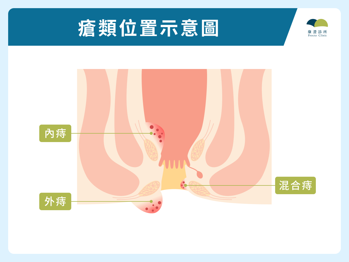 3 大痔瘡類型與位置