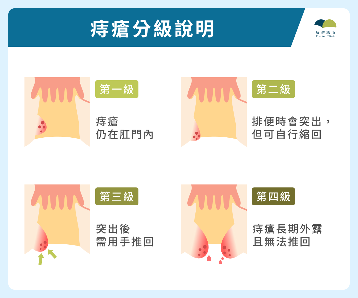 痔瘡分級說明