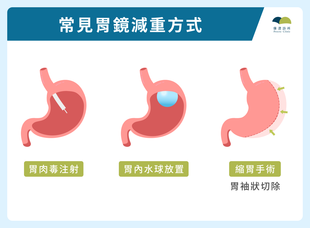 常見胃鏡減重方式